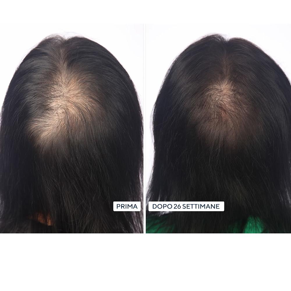QVC HairMax LaserBand Dispositivo laser crescita capellI Italia